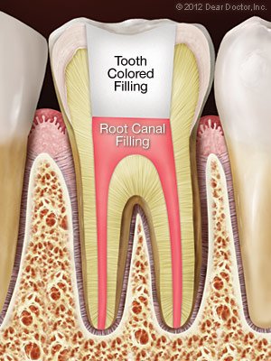 Root Canal Treatment | Dentist In Addison, IL | Elite Dentistry