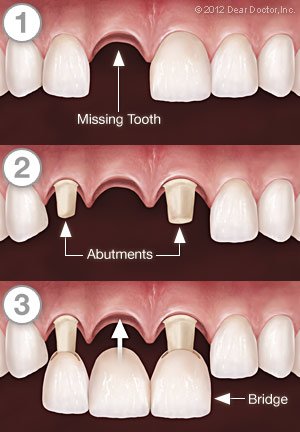 Dental Crowns | Dentist In Addison, IL | Elite Dentistry