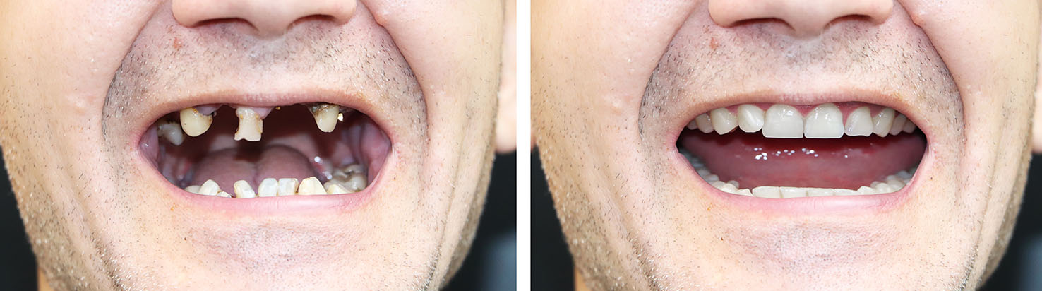 Elite Dentistry | Periodontal Treatment, Dental Sealants and Inlays  amp  Onlays