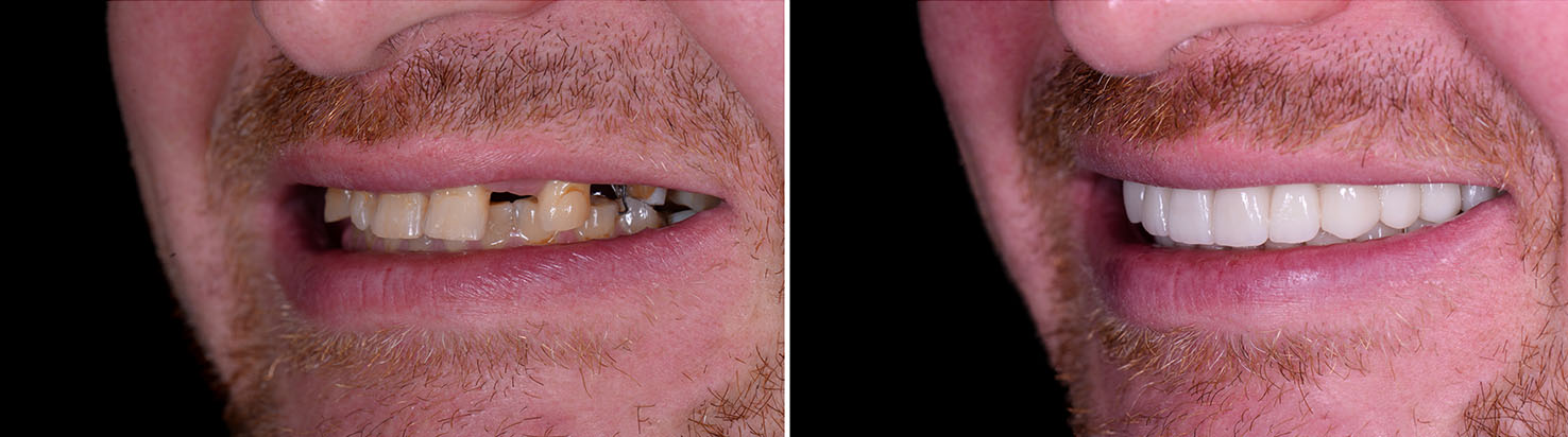 Elite Dentistry | Dental Fillings, Oral Cancer Screening and LANAP reg